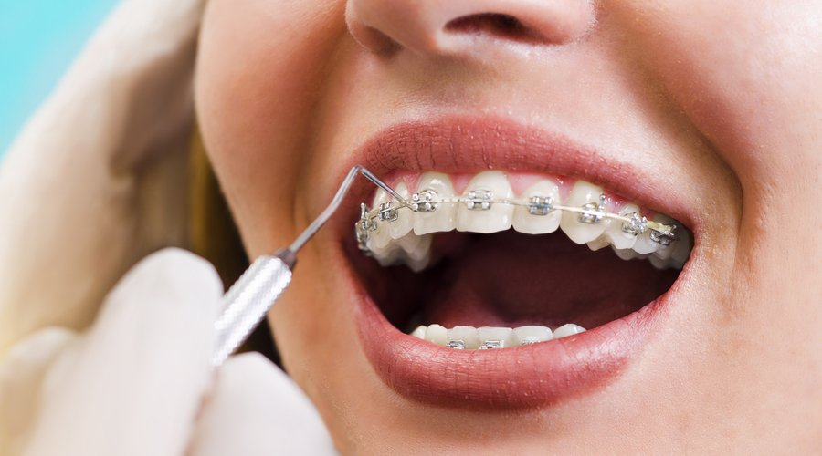 La ANMAT prohibió la venta de brackets por riesgo a la salud
