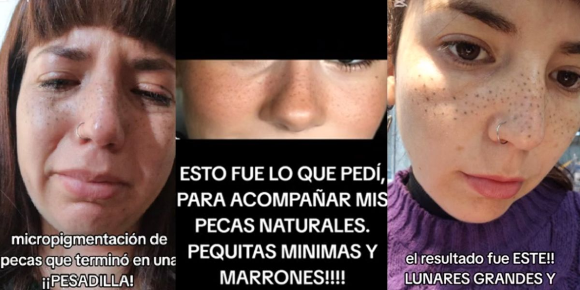 El desgarrador testimonio de una joven platense que quiso tener pecas y terminó con marcas tatuadas: “Evito salir”