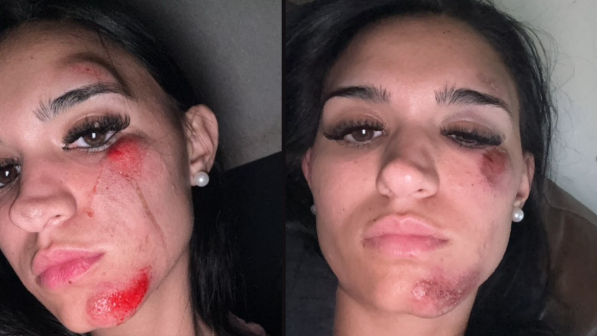 City Bell: dos jóvenes resultaron heridas en un choque y denuncian que el automovilista escapó